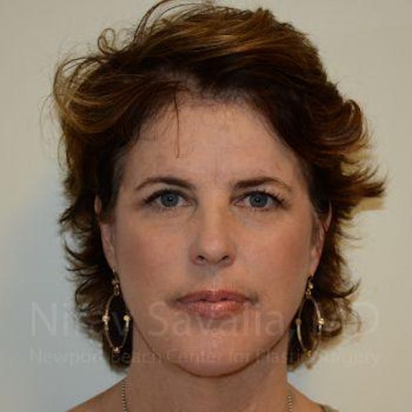 Facelift Before & After Gallery - Patient 1655689 - Image 4