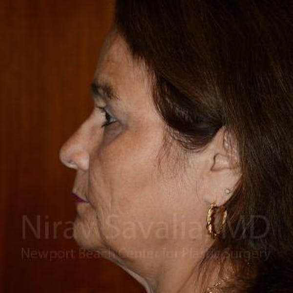 Brow Lift Before & After Gallery - Patient 1655687 - Image 4
