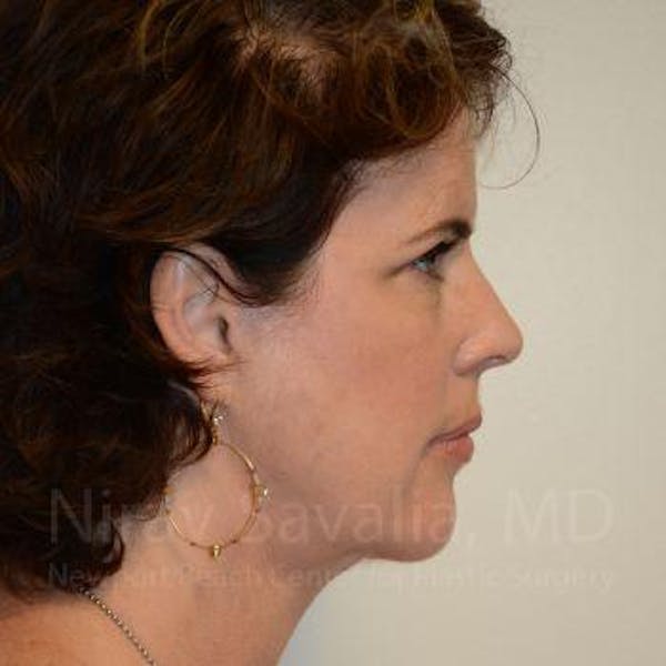 Fat Grafting to Face Before & After Gallery - Patient 1655688 - Image 4