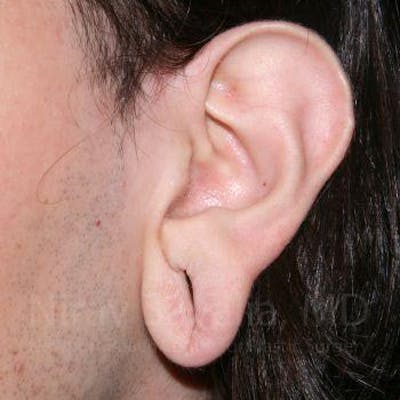 Torn Earlobe Repair / Ear Gauge Repair Before & After Gallery - Patient 1655686 - Image 1
