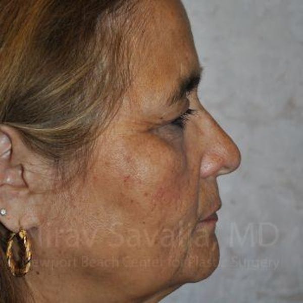 Brow Lift Before & After Gallery - Patient 1655687 - Image 5