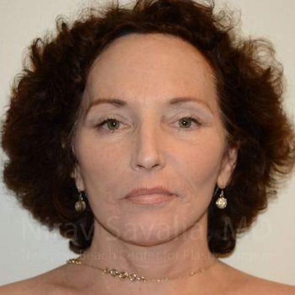 Eyelid Surgery Before & After Gallery - Patient 1655690 - Image 4