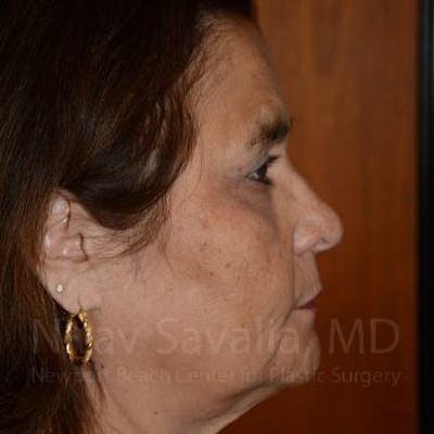 Brow Lift Before & After Gallery - Patient 1655687 - Image 6