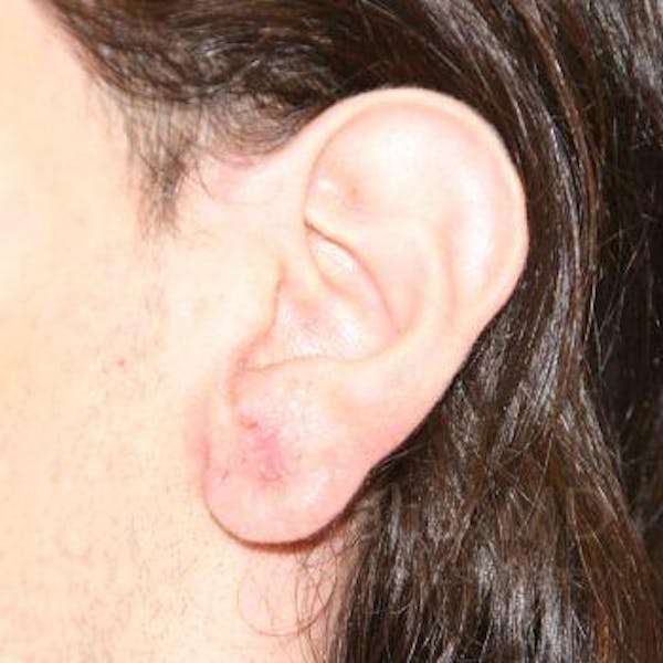 Torn Earlobe Repair / Ear Gauge Repair Before & After Gallery - Patient 1655686 - Image 2