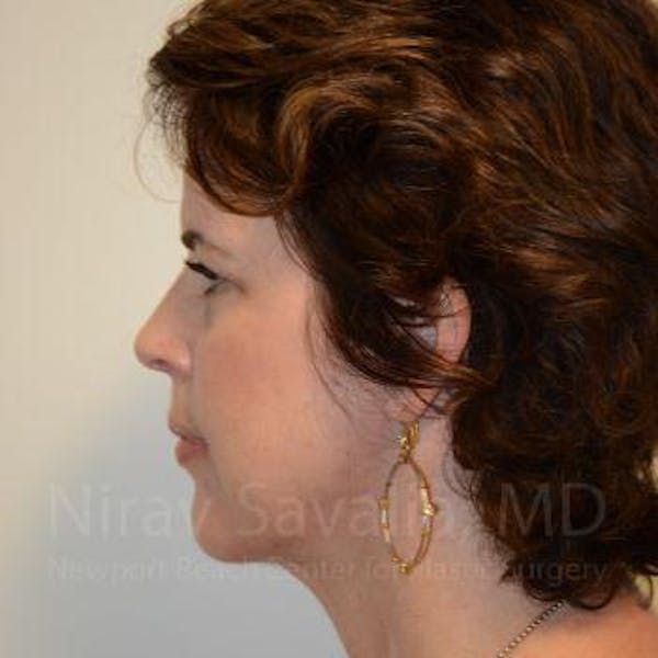 Facelift Before & After Gallery - Patient 1655689 - Image 6
