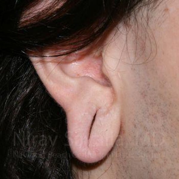 Torn Earlobe Repair / Ear Gauge Repair Gallery - Patient 1655686 - Image 3