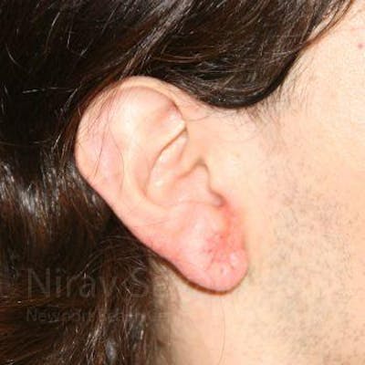 Torn Earlobe Repair / Ear Gauge Repair Gallery - Patient 1655686 - Image 4