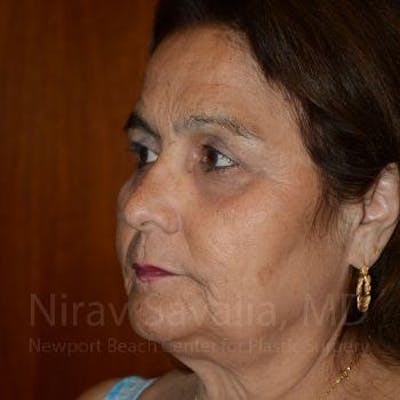 Brow Lift Before & After Gallery - Patient 1655687 - Image 8