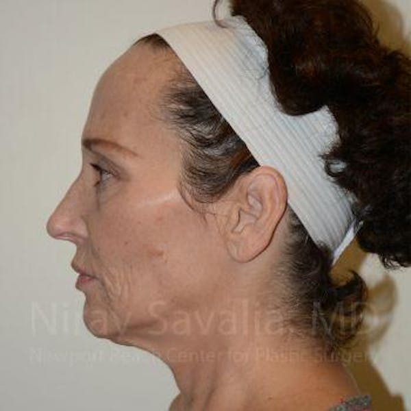 Eyelid Surgery Before & After Gallery - Patient 1655690 - Image 9