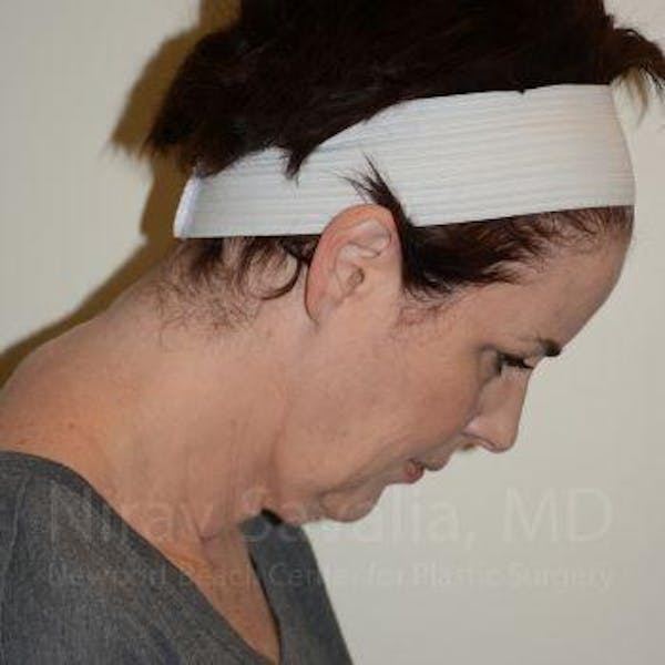 Facelift Before & After Gallery - Patient 1655689 - Image 11