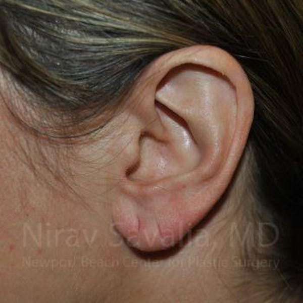 Torn Earlobe Repair / Ear Gauge Repair Before & After Gallery - Patient 1655691 - Image 1
