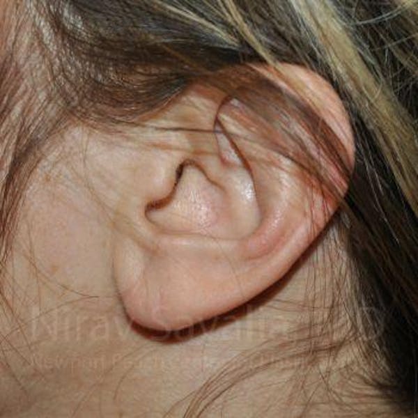 Torn Earlobe Repair / Ear Gauge Repair Before & After Gallery - Patient 1655691 - Image 2