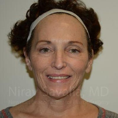 Fat Grafting to Face Before & After Gallery - Patient 1655693 - Image 1