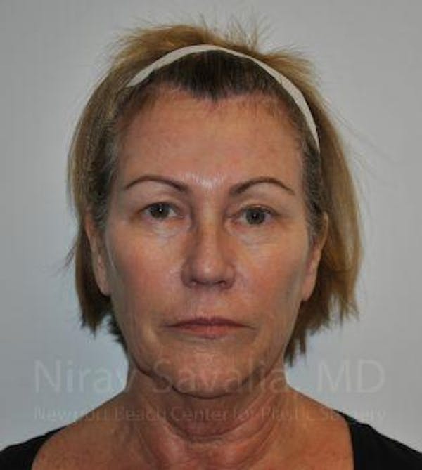 Facelift Before & After Gallery - Patient 1655695 - Image 3