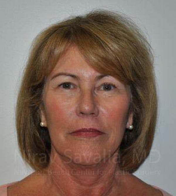 Facelift Before & After Gallery - Patient 1655695 - Image 4