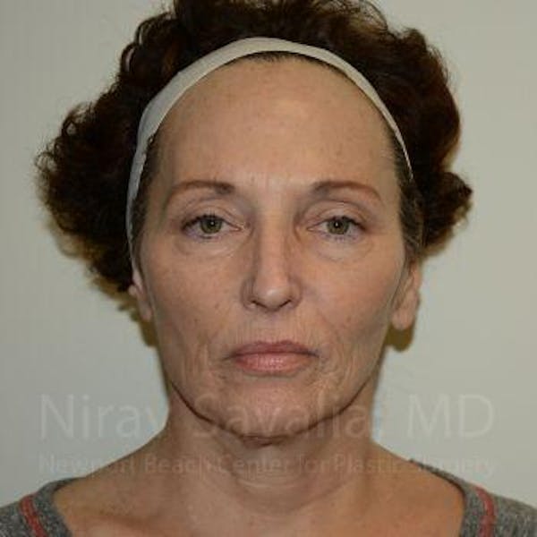 Fat Grafting to Face Before & After Gallery - Patient 1655693 - Image 3