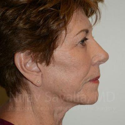 Brow Lift Before & After Gallery - Patient 1655696 - Image 4