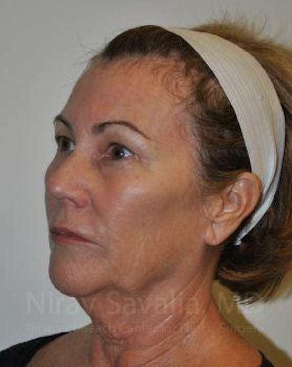 Facelift Before & After Gallery - Patient 1655695 - Image 5