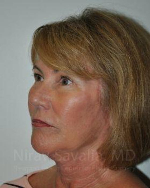 Facelift Before & After Gallery - Patient 1655695 - Image 6