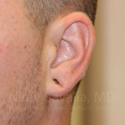 Torn Earlobe Repair / Ear Gauge Repair Before & After Gallery - Patient 1655692 - Image 1