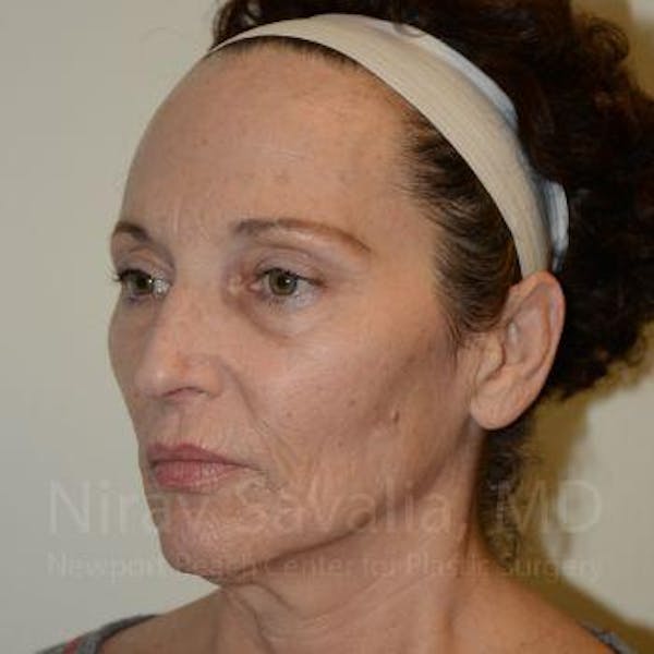 Fat Grafting to Face Before & After Gallery - Patient 1655693 - Image 5