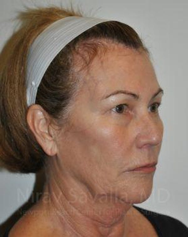 Facelift Before & After Gallery - Patient 1655695 - Image 7