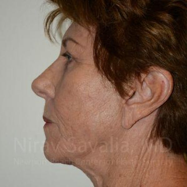 Brow Lift Before & After Gallery - Patient 1655696 - Image 6