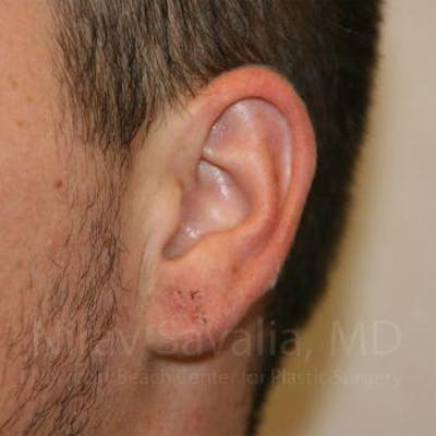 Torn Earlobe Repair / Ear Gauge Repair Before & After Gallery - Patient 1655692 - Image 2