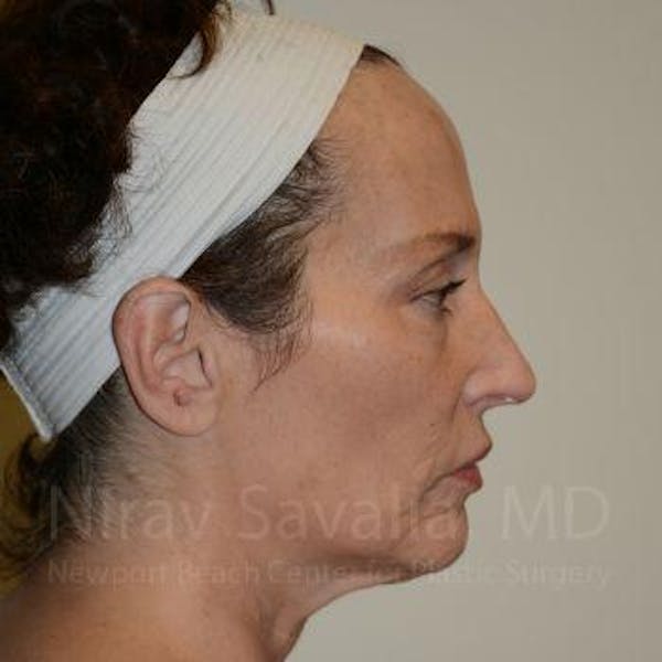 Fat Grafting to Face Before & After Gallery - Patient 1655693 - Image 7