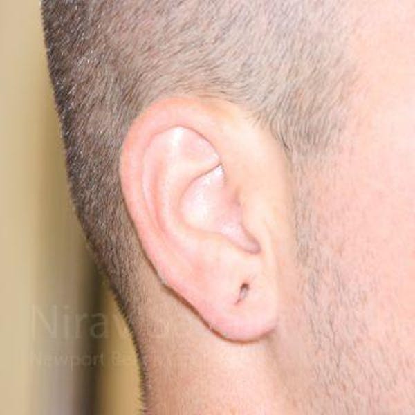 Torn Earlobe Repair / Ear Gauge Repair Before & After Gallery - Patient 1655692 - Image 3