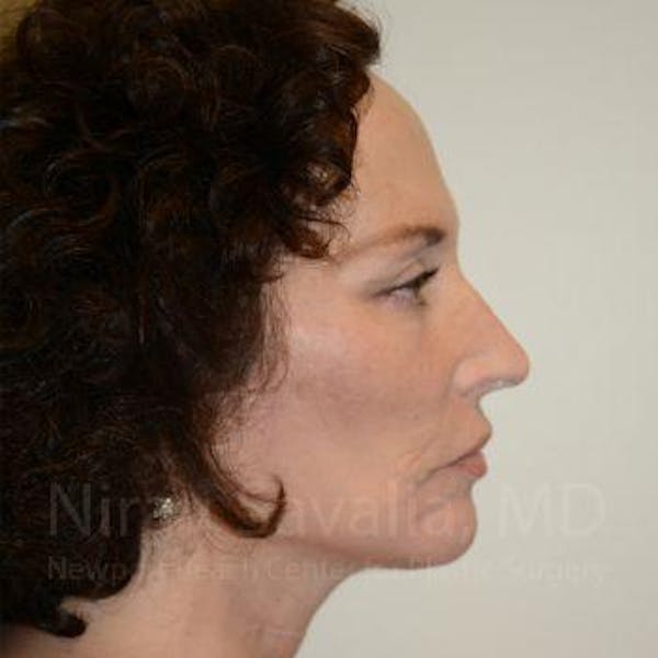 Fat Grafting to Face Before & After Gallery - Patient 1655693 - Image 8