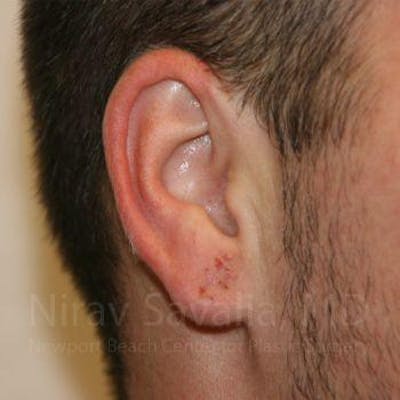 Torn Earlobe Repair / Ear Gauge Repair Before & After Gallery - Patient 1655692 - Image 4