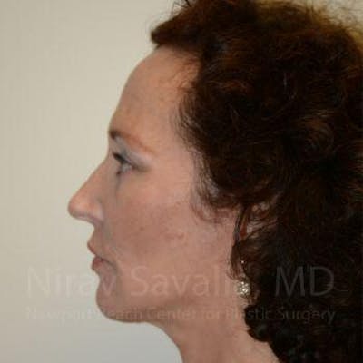 Fat Grafting to Face Gallery - Patient 1655693 - Image 10