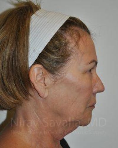 Facelift Before & After Gallery - Patient 1655695 - Image 1