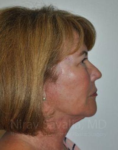 Facelift Before & After Gallery - Patient 1655695 - Image 2