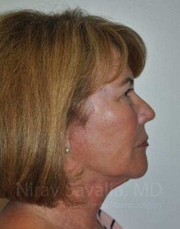 Facelift Before & After Gallery - Patient 1655695 - Image 2