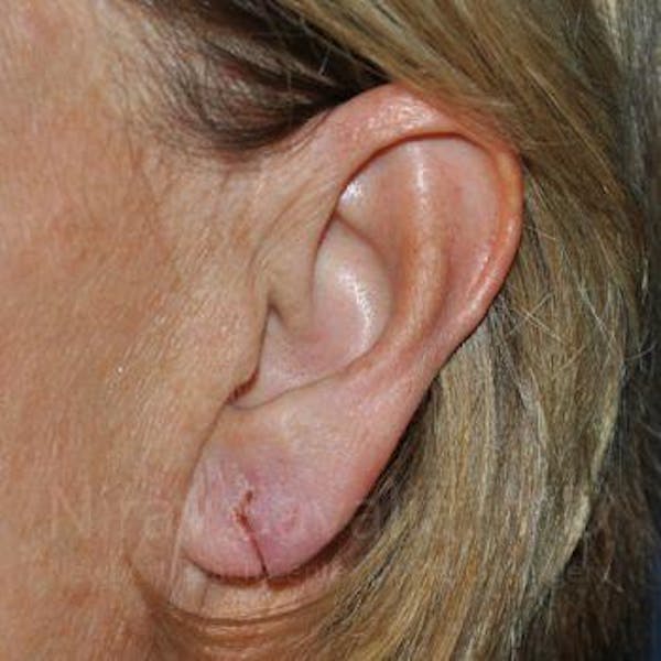 Torn Earlobe Repair / Ear Gauge Repair Before & After Gallery - Patient 1655697 - Image 1