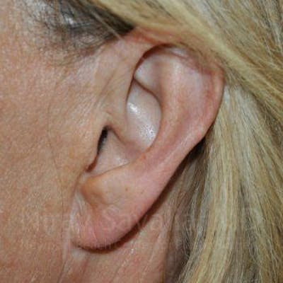 Torn Earlobe Repair / Ear Gauge Repair Before & After Gallery - Patient 1655697 - Image 2