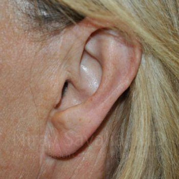Torn Earlobe Repair / Ear Gauge Repair Before & After Gallery - Patient 1655697 - Image 2