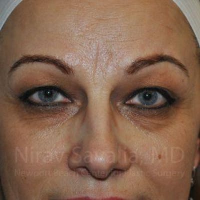 Eyelid Surgery Before & After Gallery - Patient 1655701 - Image 1