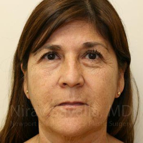 Brow Lift Before & After Gallery - Patient 1655702 - Image 1