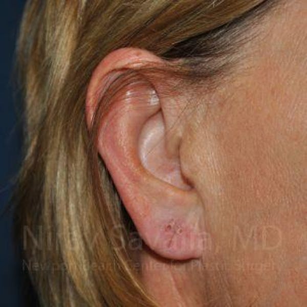 Torn Earlobe Repair / Ear Gauge Repair Before & After Gallery - Patient 1655697 - Image 3