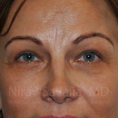 Eyelid Surgery Before & After Gallery - Patient 1655701 - Image 2