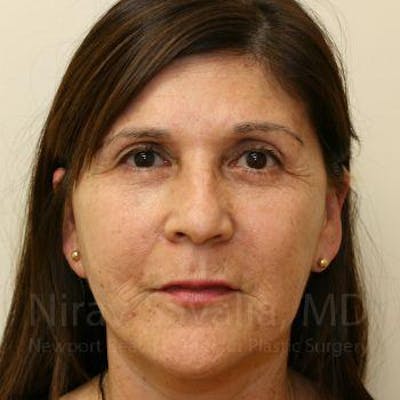 Brow Lift Before & After Gallery - Patient 1655702 - Image 2