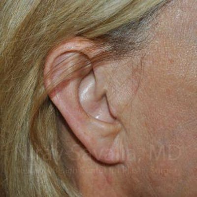 Torn Earlobe Repair / Ear Gauge Repair Before & After Gallery - Patient 1655697 - Image 4