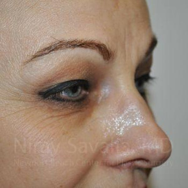 Eyelid Surgery Before & After Gallery - Patient 1655701 - Image 3