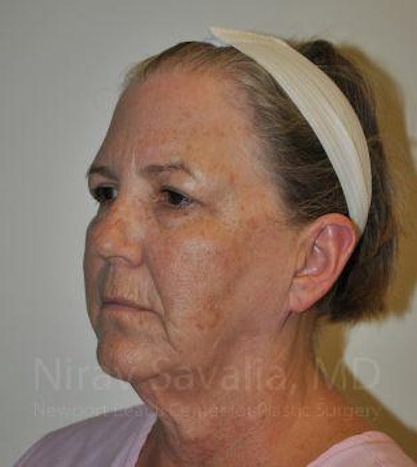 Facelift Before & After Gallery - Patient 1655699 - Image 5