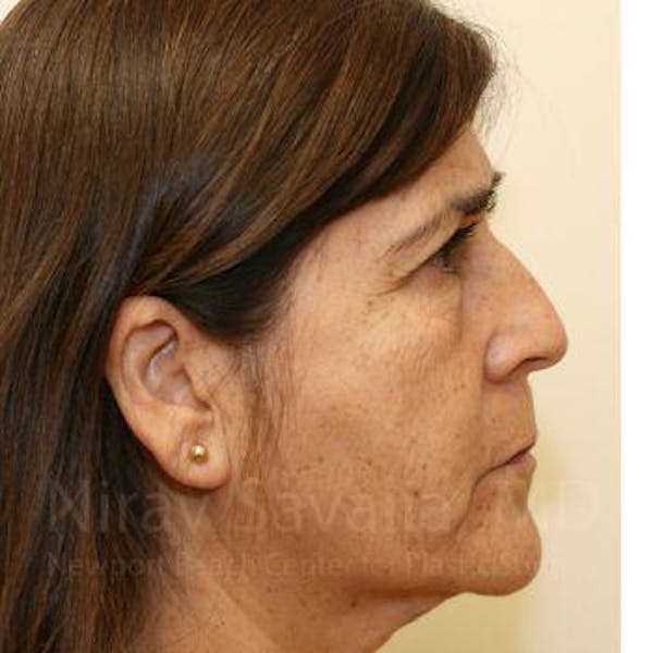 Brow Lift Before & After Gallery - Patient 1655702 - Image 3