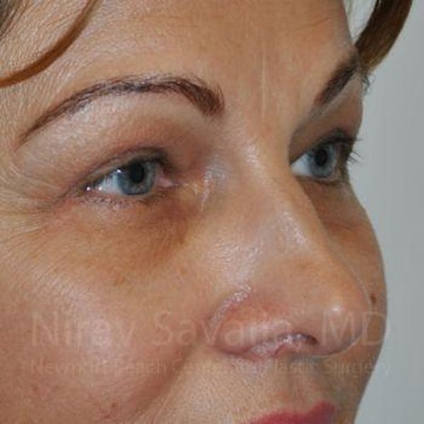 Eyelid Surgery Before & After Gallery - Patient 1655701 - Image 4