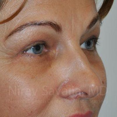 Eyelid Surgery Before & After Gallery - Patient 1655701 - Image 4